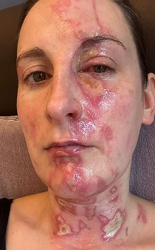 Cecily Beer: 'The Blender’s Lid Flew Off, Covering My Face in Molten Liquid – Now I May Need a Skin Graft'