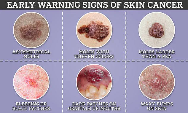 Melanoma in the Eyes: A Hidden Threat with Limited Public Access