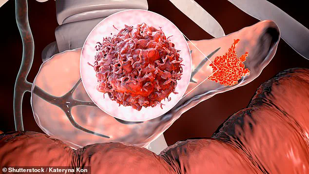 Breakthrough Blood Test Offers New Hope for Early Pancreatic Cancer Detection