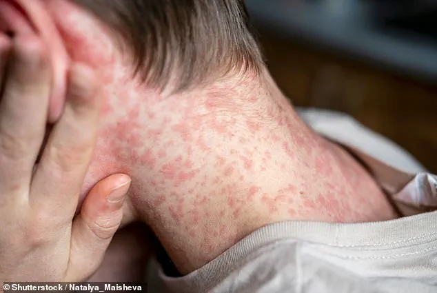 Measles Outbreak at Dilley Immigration Processing Center Triggers Lockdown and Quarantine Measures