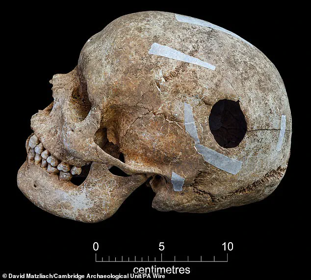 Viking-era Burial Pit Unearths Mutilated Remains, Raising Questions About Ancient Surgery and Violence in Cambridge