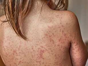 Health Officials Warn March for Life Rally Attendees of Possible Measles Exposure