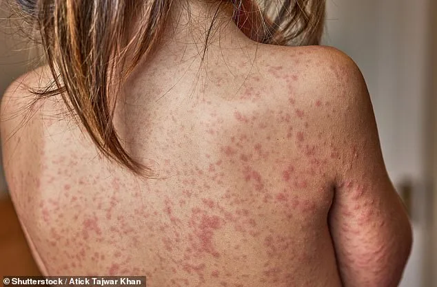 Measles Outbreak Alarms London as Cases Surge Among Young Children, Warns UKHSA