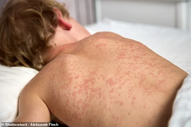 Measles Exposure Alert at Philadelphia Airport: Unvaccinated Travelers Face 90% Infection Risk
