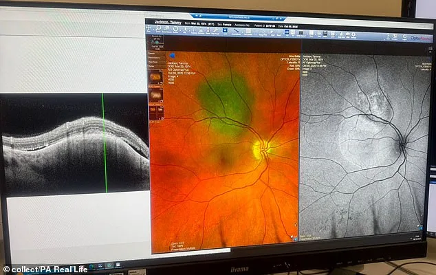 Tammy Jackson's Fight Against Rare Eye Cancer Fuels Her Mission to Promote Early Screenings