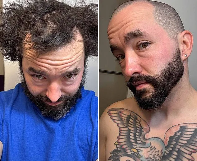 r/bald: Hair Loss to Confidence in a Supportive Online Community