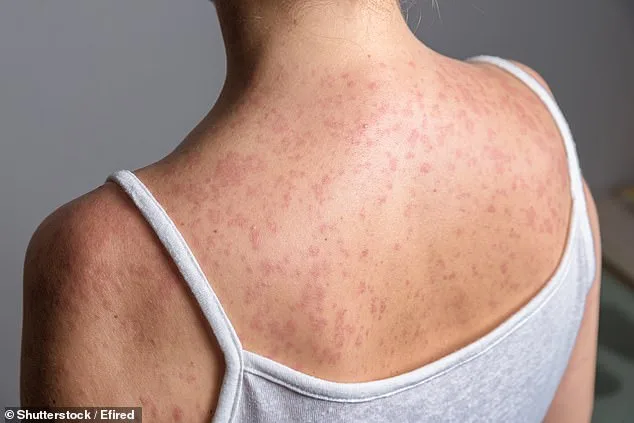 Typhoid Fever Resurges With Drug Resistance, Fueling Global Health Concerns