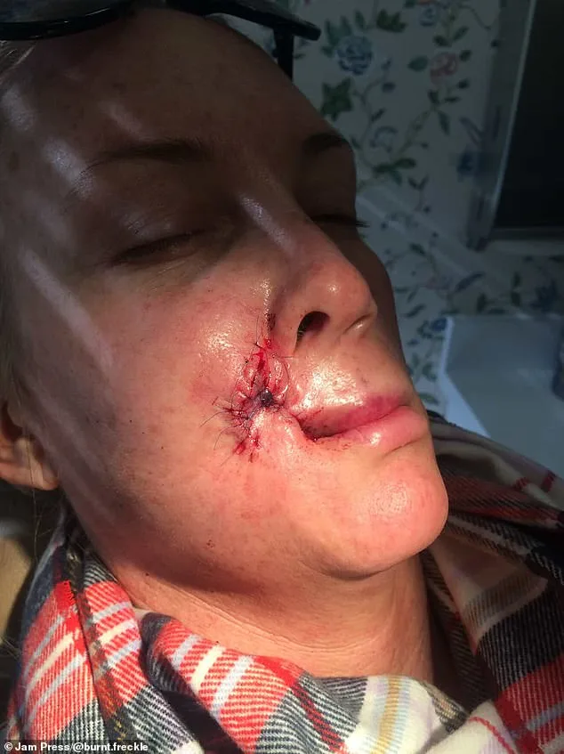 Kory Feltz's 20-Year Relentless Battle with Skin Cancer: From Calf to Lip, a Recurrence That Refuses to Fade