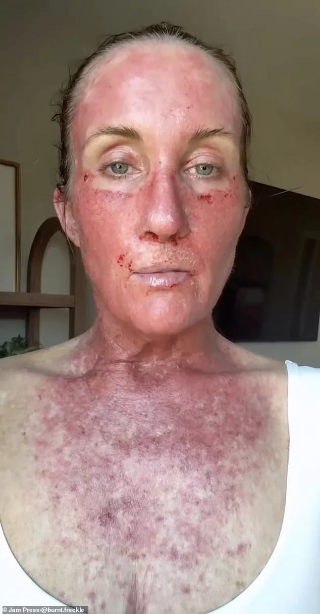 Kory Feltz's 20-Year Relentless Battle with Skin Cancer: From Calf to Lip, a Recurrence That Refuses to Fade
