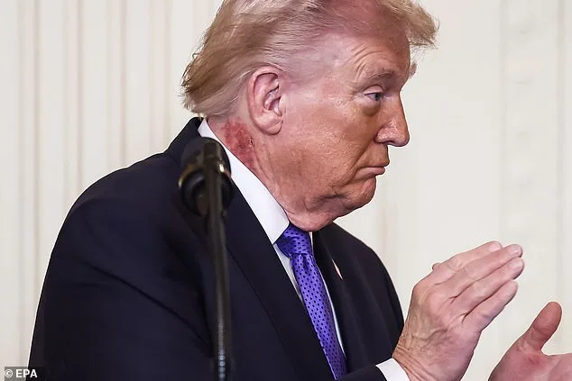 Trump's Neck Rash Sparks Health Concerns and Speculation Over Cause
