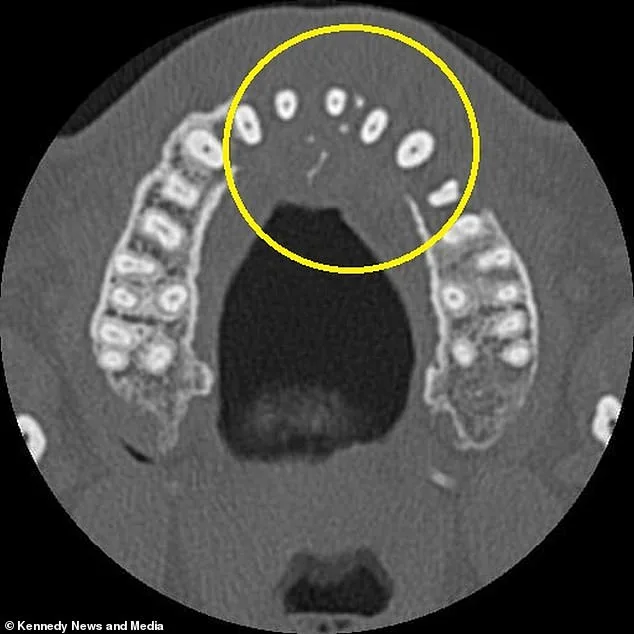 Toothache Turns Deadly: Man's Warning About Aggressive Blood Cancer