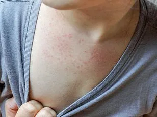 Human Metapneumovirus Spikes in U.S., CDC Warns of Rising Cases Without Vaccine