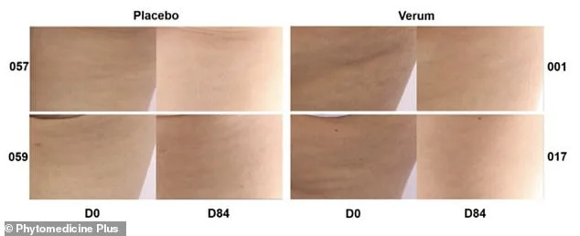 Pycnogenol: A Natural Oral Solution for Cellulite Shows Promising Results in 90-Day Clinical Study