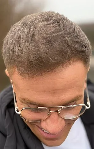 Social Media Creator's Hair Loss Crisis: Confidence Shattered, Hair Fibers Become Lifeline