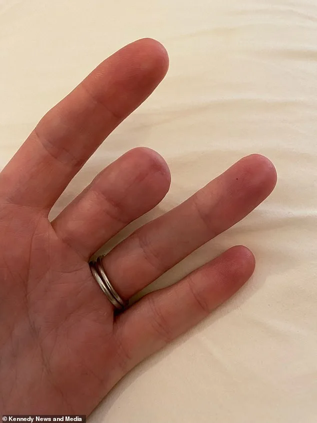 A Faint Brown Line Under the Nail: The Hidden Danger of Subungual Melanoma