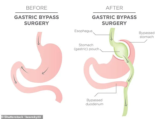NHS in England Sees Tripling of Weight-Loss Surgeries as Obesity Treatment Demand Rises