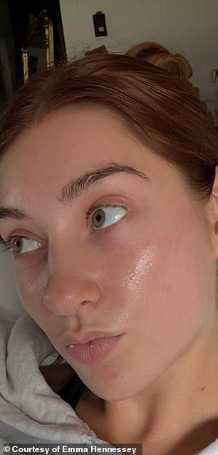 Celebrities praise microdose isotretinoin for youthful skin despite hidden dangers.